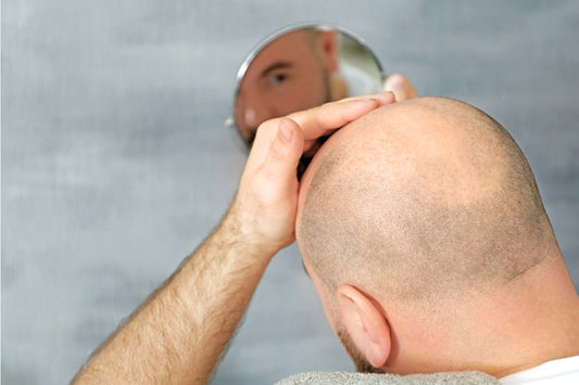 Calvicie y Pérdida de Cabello en Hombres: El Cuidado del Cuero Cabelludo Importa